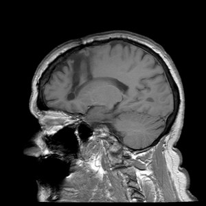 MRI mózgu po leukotomii